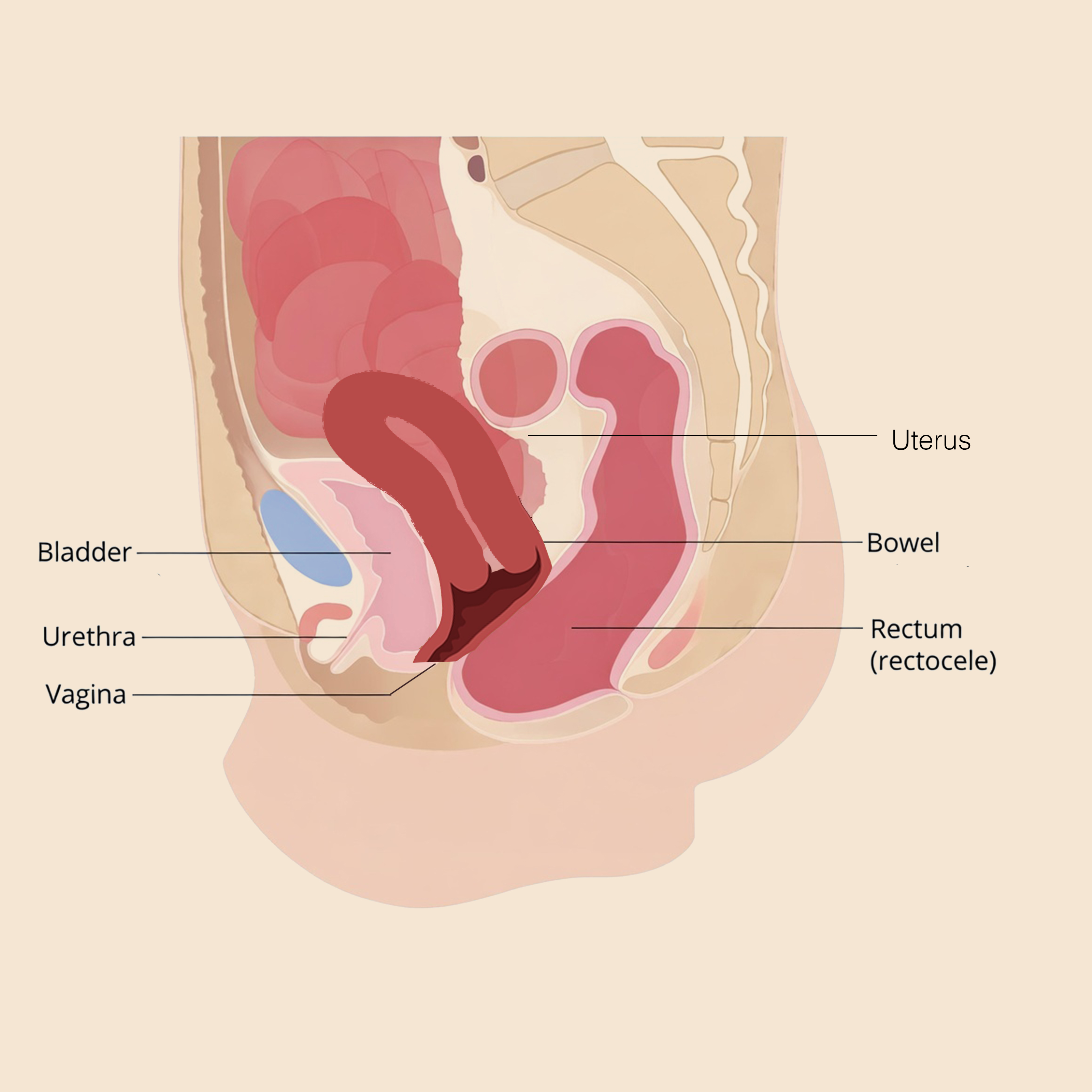 Rectocele / Enterocele